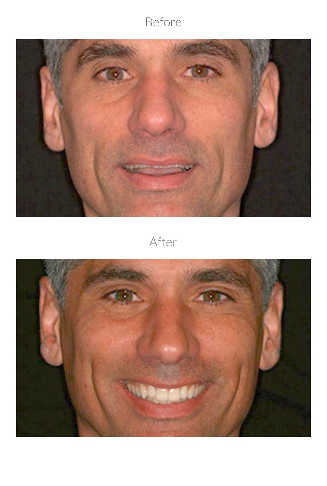 Before and after dental procedure smile transformation.