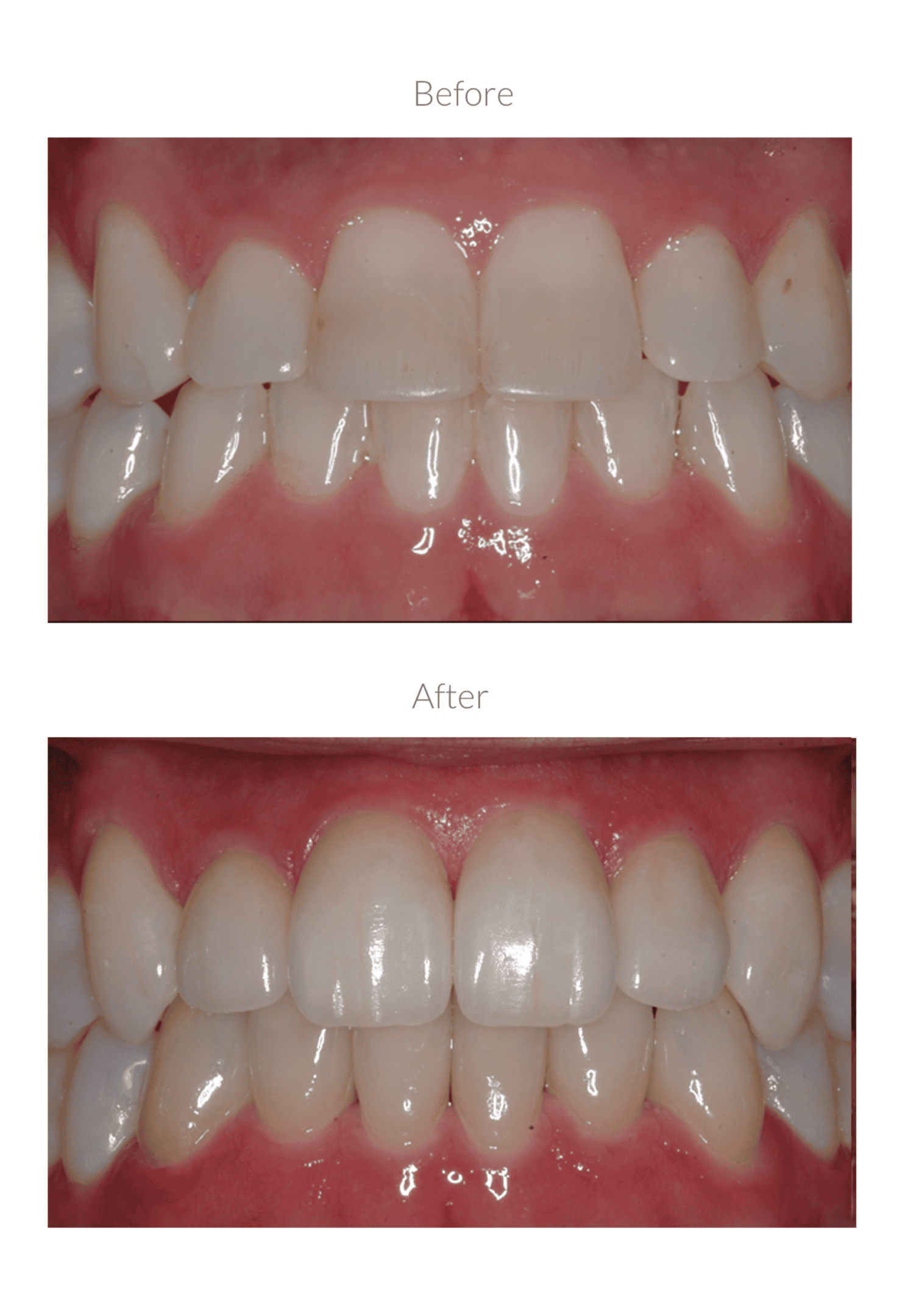 Teeth whitening results shown before and after