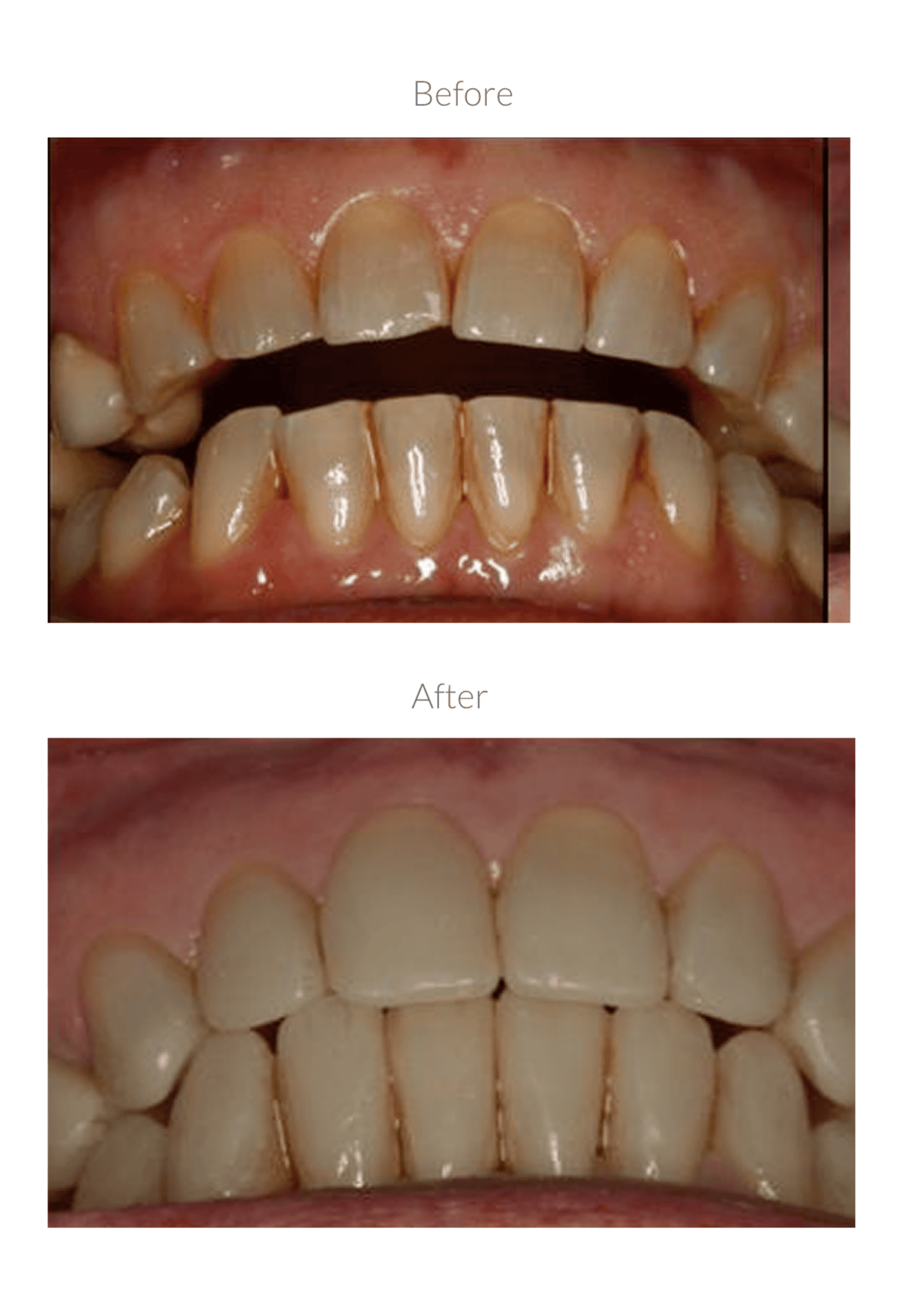Improved smile after dental procedure