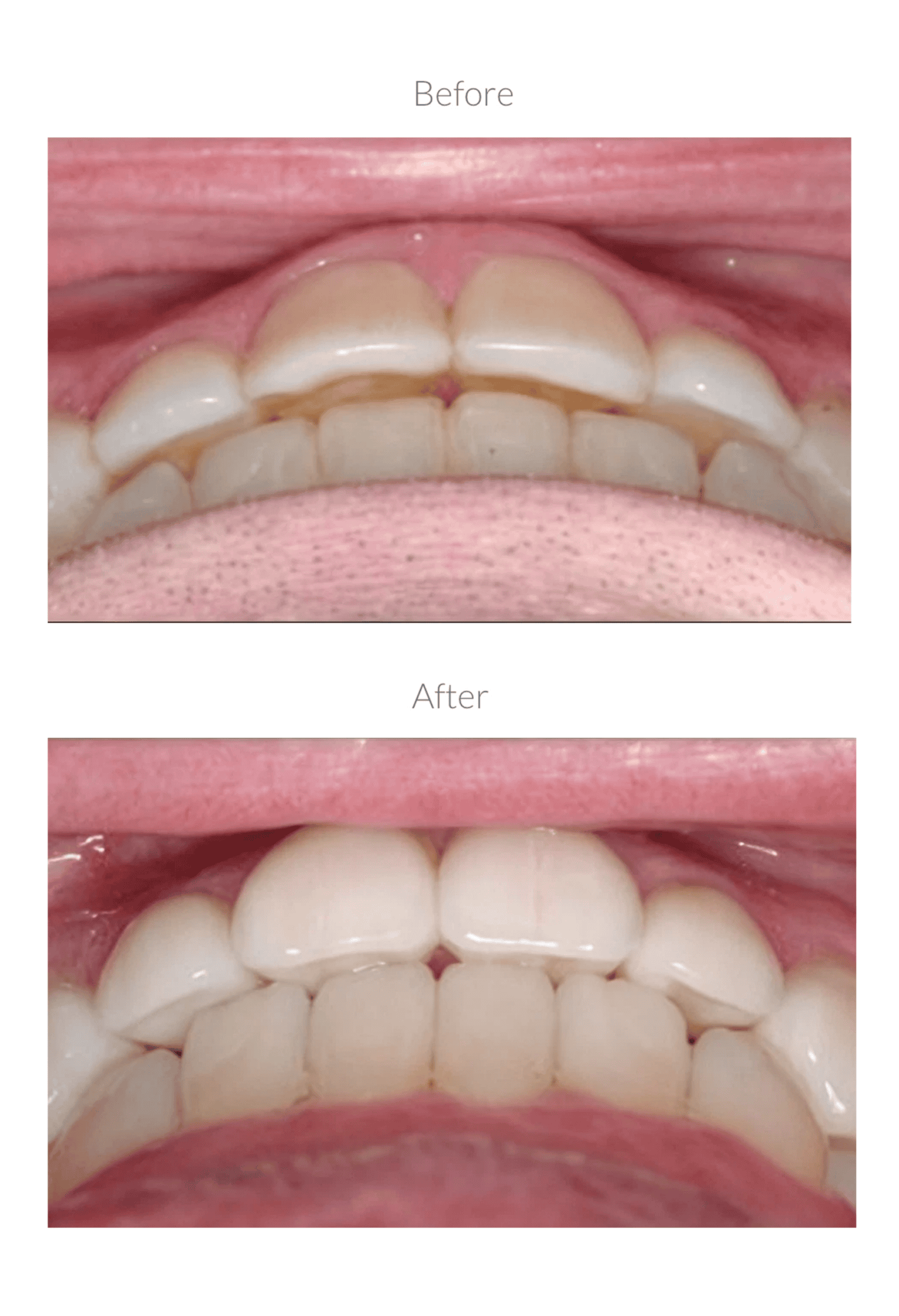 Teeth before and after dental treatment