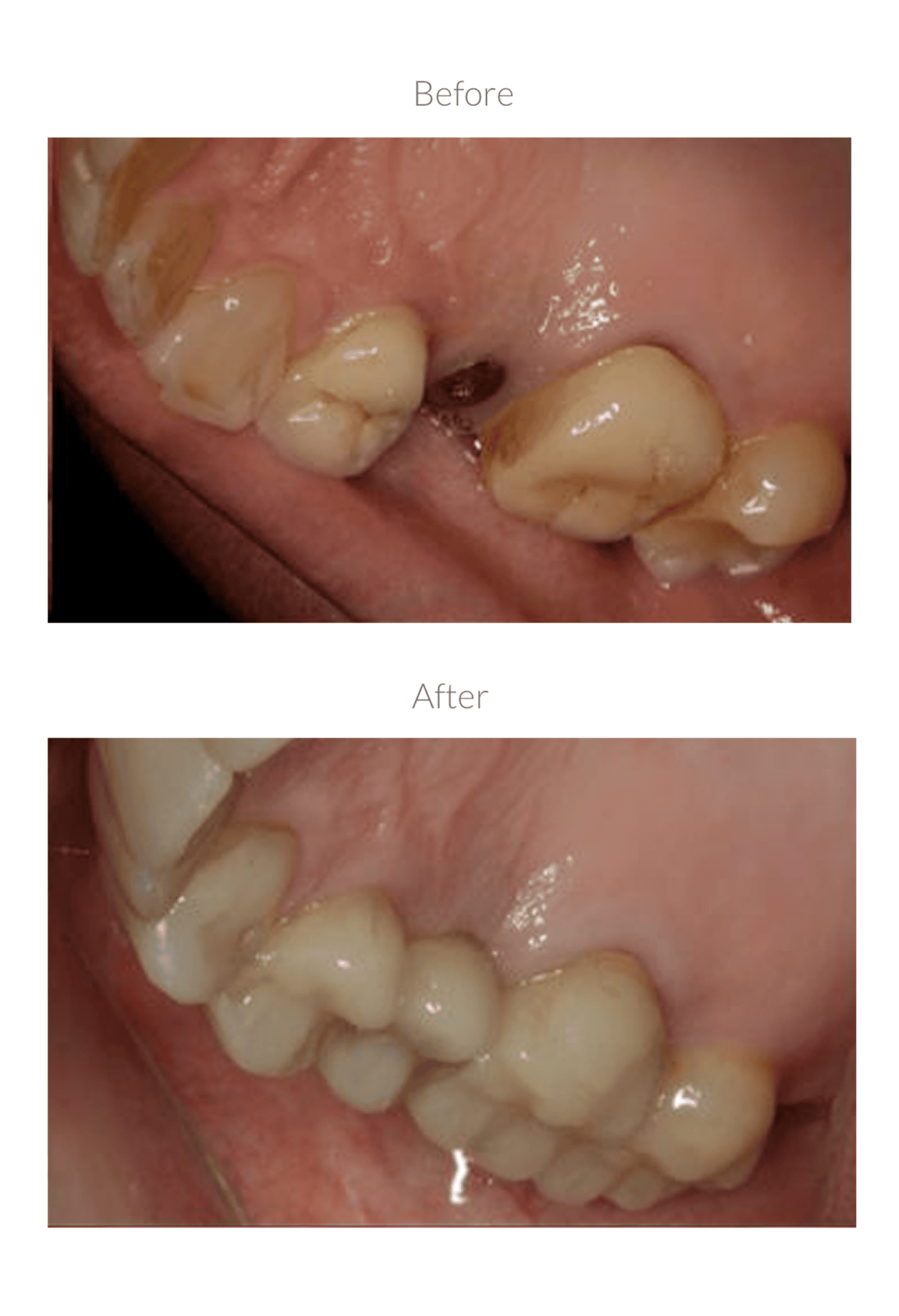 Tooth decay treatment transformation
