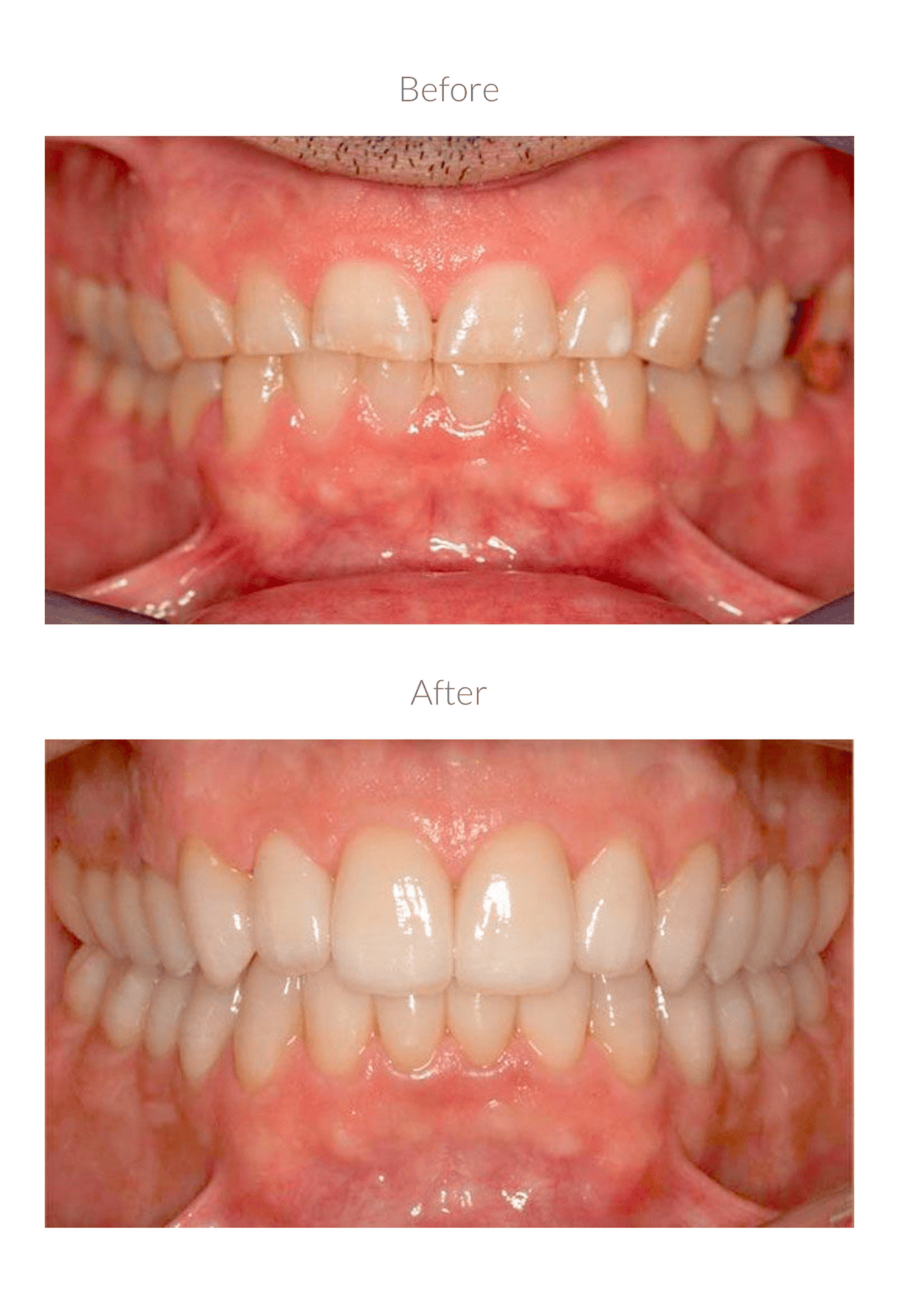 Teeth alignment before and after treatment